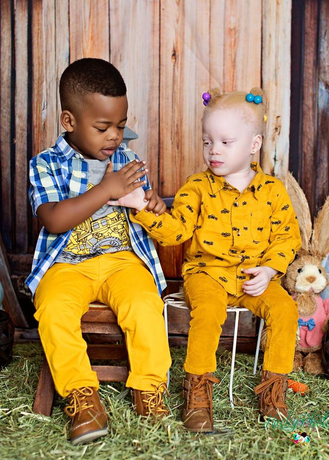 Urodziłam czarno-białe bliźniaki! Niezwykłe rodzeństwo 