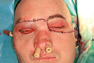 Przeszczep twarzy w Gliwicach: Gałki oczne zwisały mu z twarzy