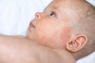 Rośnie liczba alergii po antybiotykach u dzieci. Lekarz wskazał największego winowajcę
