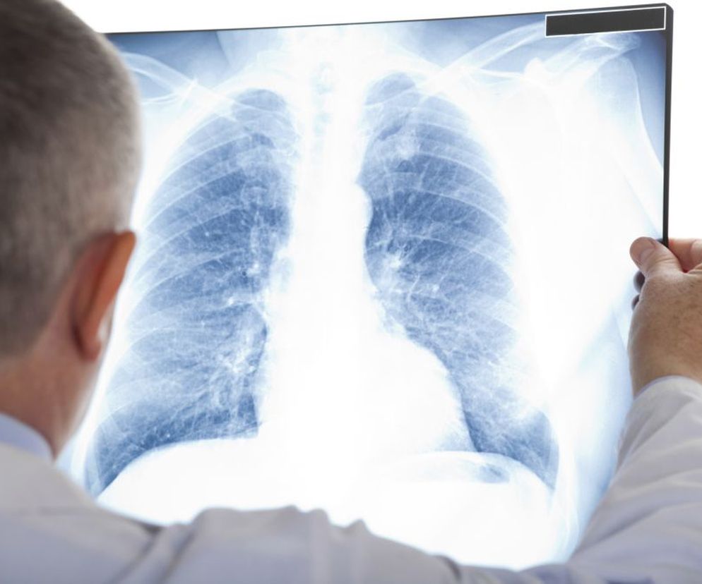 Sarkoidoza polega na gromadzeniu się komórek układu odpornościowego w formie ziarniny w płucach i innych narządach.