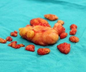 Tłuszczaki - rodzaje. Przyczyny, objawy, usuwanie