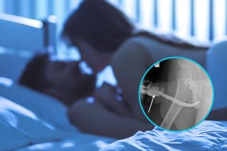 Niezwykle rzadki, nagły wypadek. Podczas seksu złamał penisa w trzech miejscach