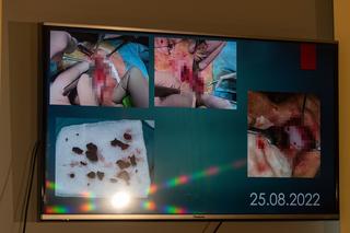 Ranny w wybuchu saper odzyskał dawny wygląd