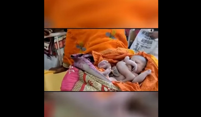Chłopiec z poliamelią, który na początku roku, urodził się w Indiach