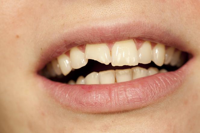 ZŁAMANY ZĄB - co robić, gdy ząb jest pęknięty, ukruszony, złamany?