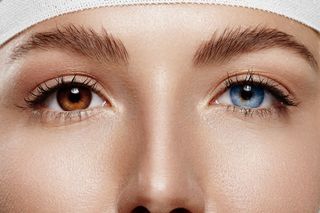 HETEROCHROMIA czyli różnobarwne tęczówki oka