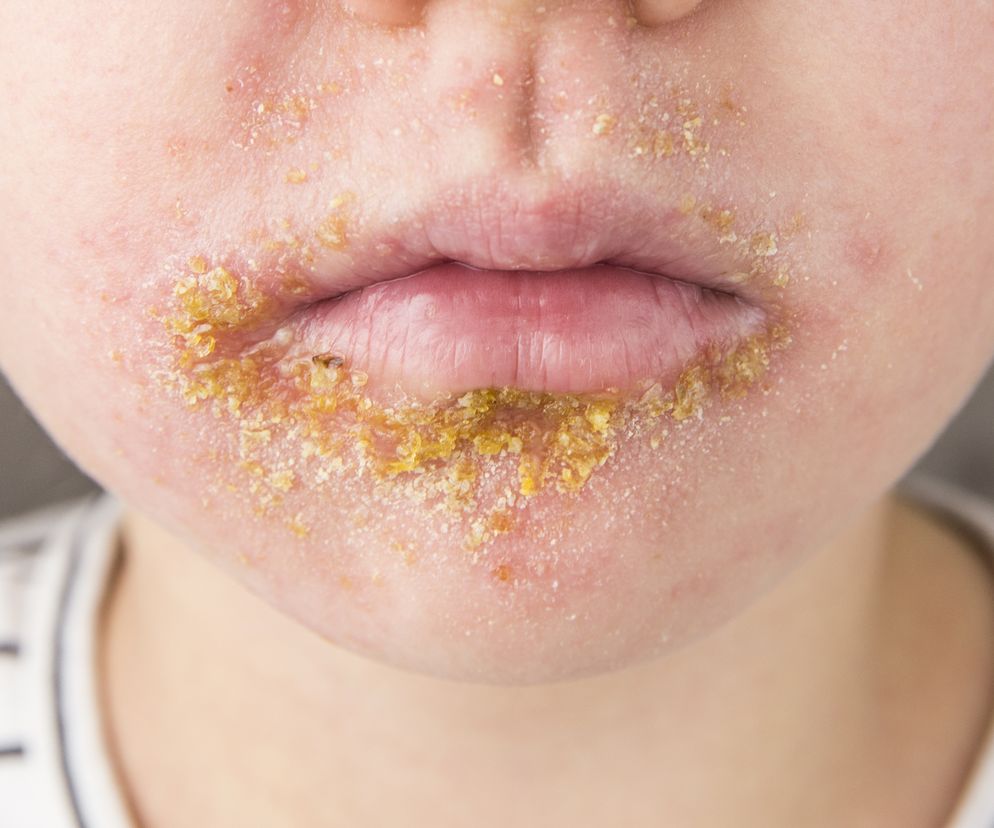 Liszajec zakaźny - przyczyny i objawy, leczenie