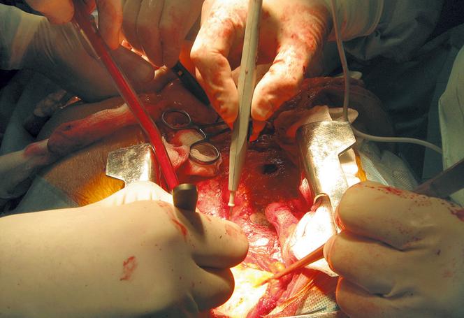 organy, handel organami, operacja