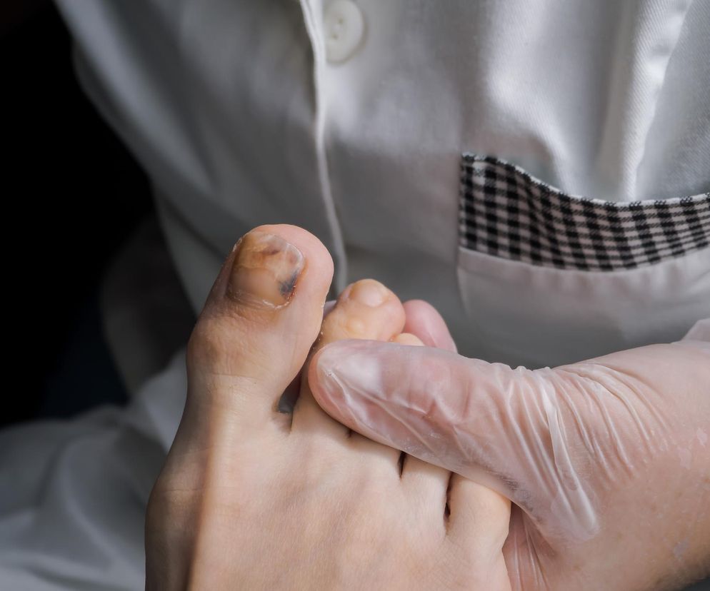 To siniak czy objaw nowotworu? Masz taką zmianę, idź do lekarza