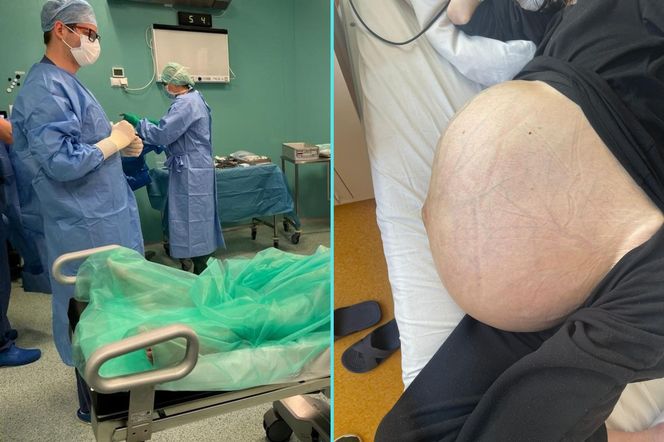 38-latka ze Świdnicy wyhodowała 20 kg guza. Ten rak długo nie daje objawów