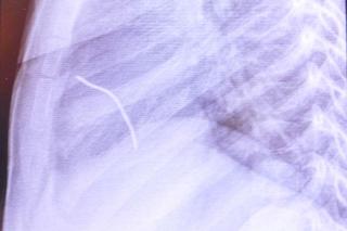 Drut przebił serce 5-letniego Przemka spod Opoczna