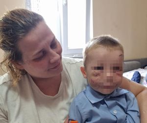 Pies pogryzł 3-latka na przystanku