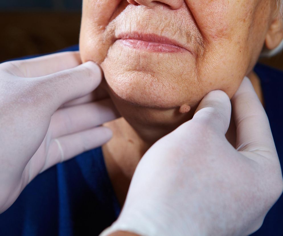 Chcieli tylko schudnąć. Leki zmieniły ich życie i twarze