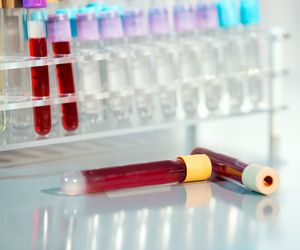 Test SGA - prosta ocena stanu odżywienia pacjenta