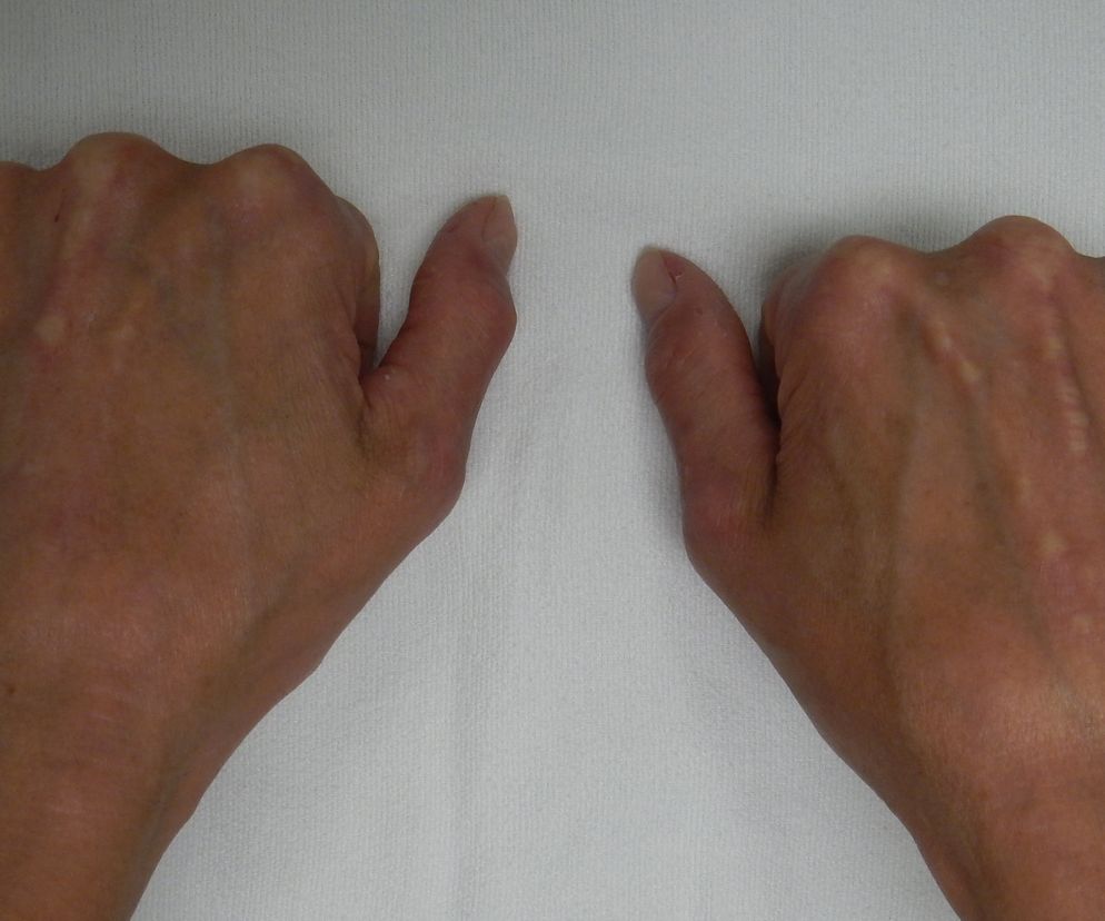 Zespół CREST - dłonie z widoczną sklerodaktylią i kalcynozą.