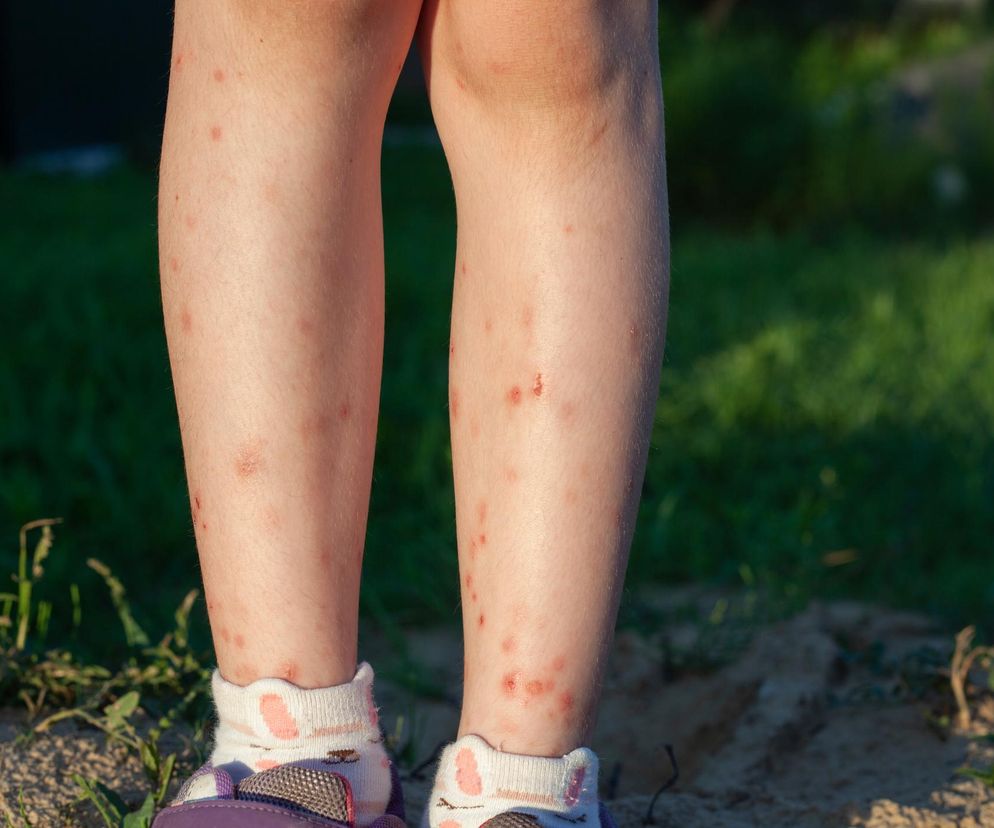 WHO ostrzega przed chikungunya. Zakażone komary są koło Polski