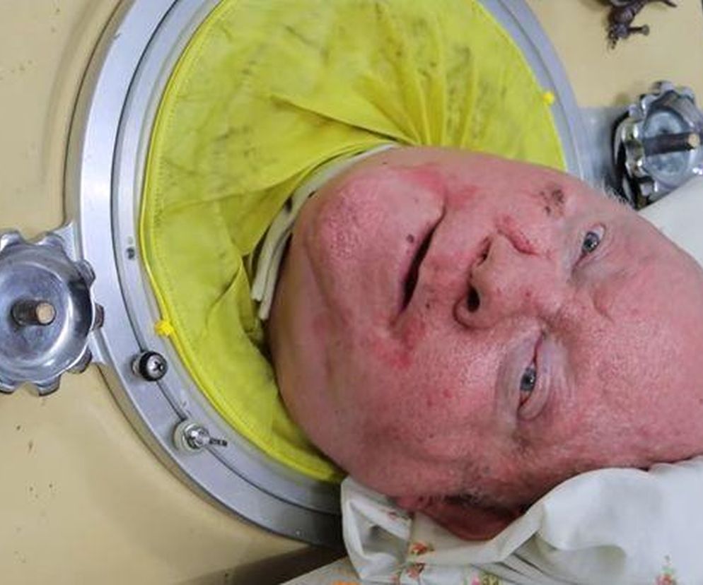 Paul Alexander nie żyje. Spędził 70 lat w sarkofagu dla chorych na polio