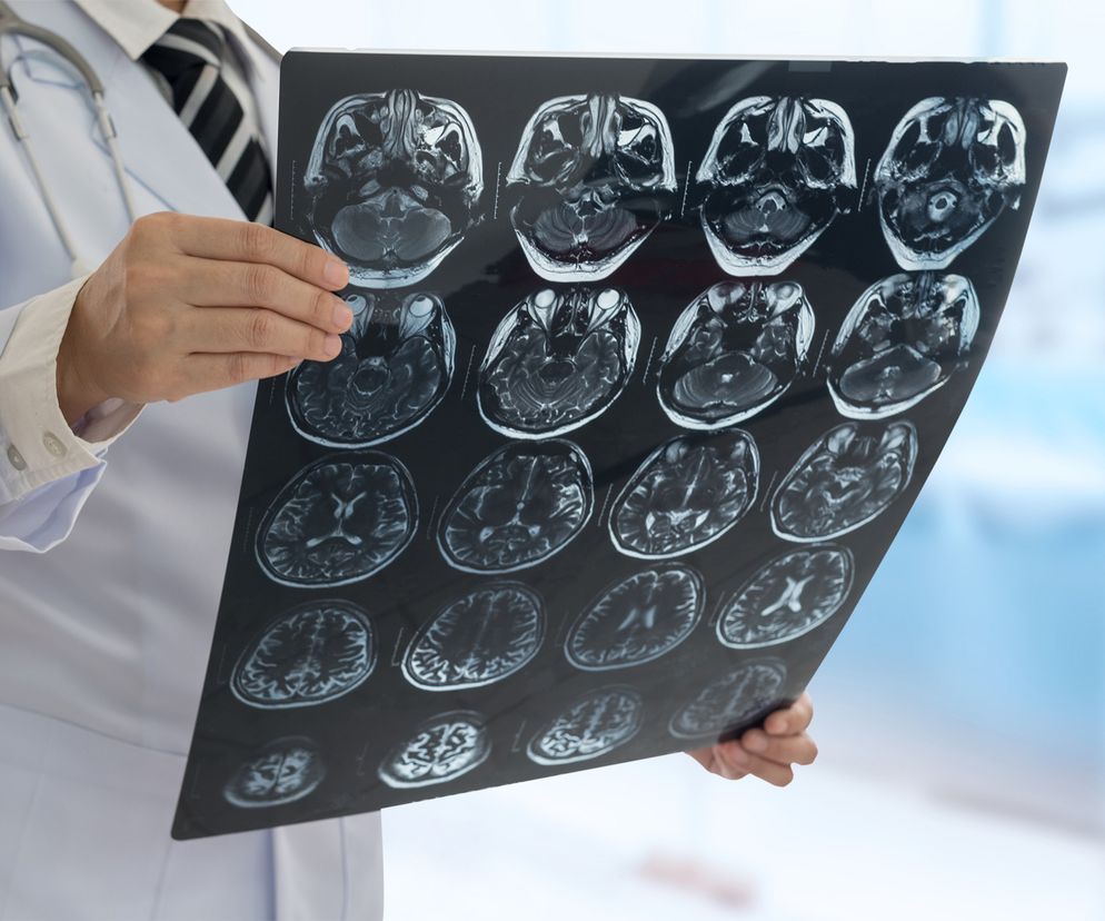 Doktor analizuje zdjęcia tomografii mózgu