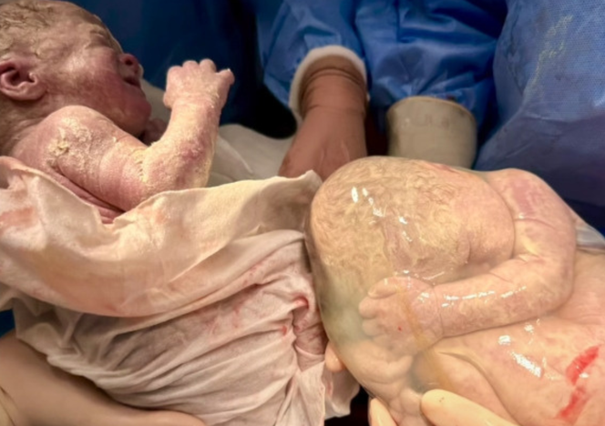 Niezwykły poród bliźniaczek w Warszawie. Jedna spała, druga krzyczała [Wideo]