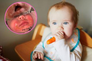 7-miesięczne dziecko z dotkliwymi oparzeniami. Mama ostrzega: wszystko przez przekąskę