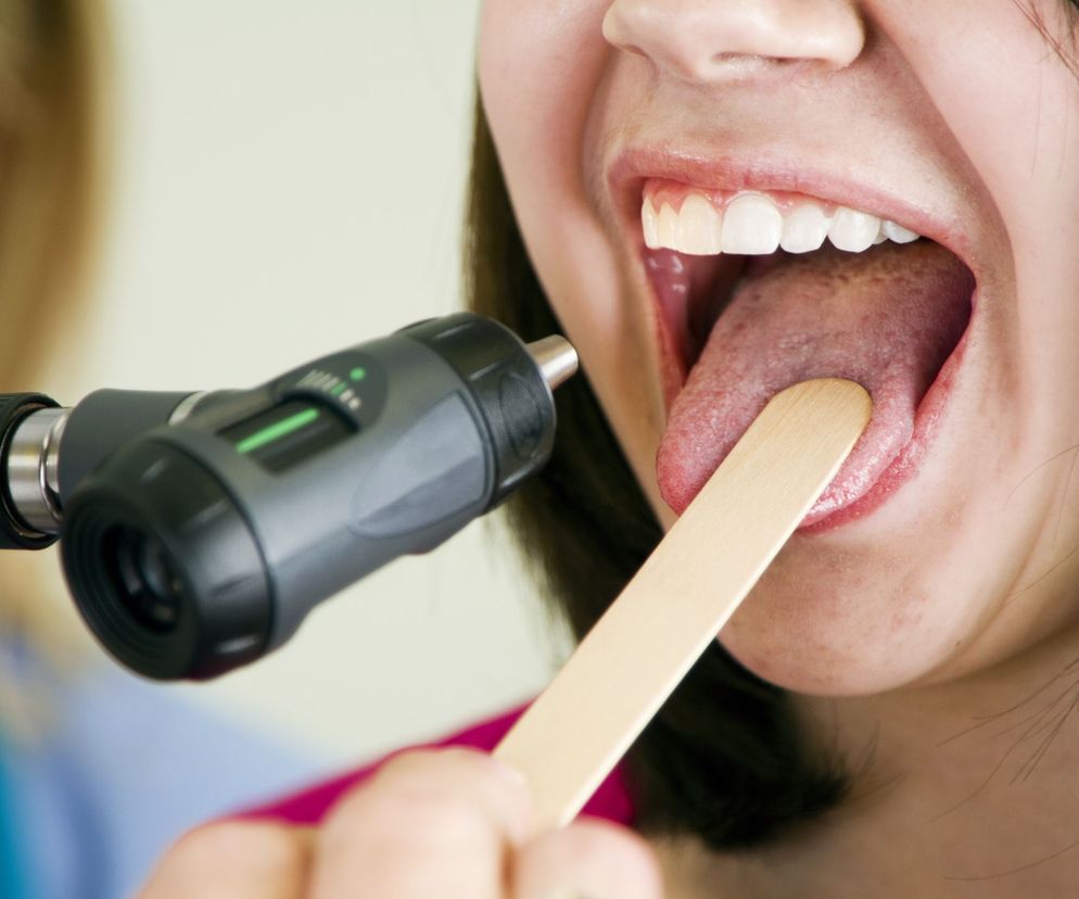 Zapalenie języka objawia się bólem i pieczeniem języka, co w znacznym stopniu obniża komfort życia.