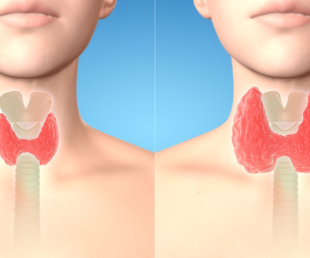 Wole obojętne tarczycy, gdy dojdzie do jego rozrostu, powoduje duszności, zaburzenia połykania i chrypę.