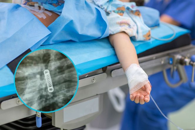 Jedynym objawem był kaszel. Lekarze znaleźli to w jego płucach