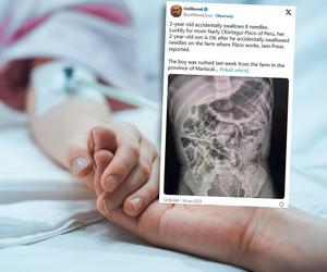 2-latek połknął osiem igieł weterynaryjnych! Był z mamą w pracy, ledwo przeżył!