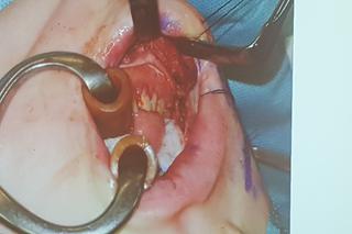 Gliwiccy lekarze dokonali kolejnego na światową skalę przeszczepu narządów szyi