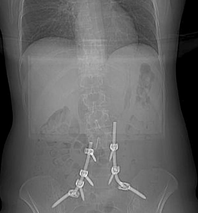 Ruszają mi się śruby w kręgosłupie