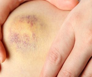 Jak pozbyć się siniaków na ciele? Sprawdzone sposoby na sińce