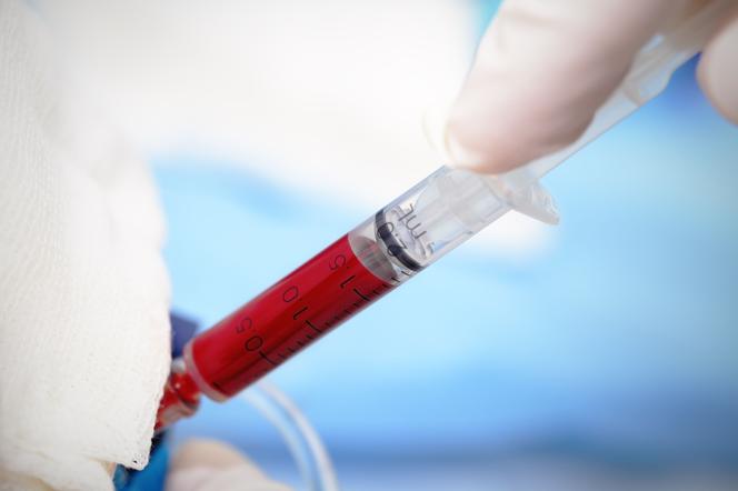 Kwas moczowy - normy w badaniu krwi