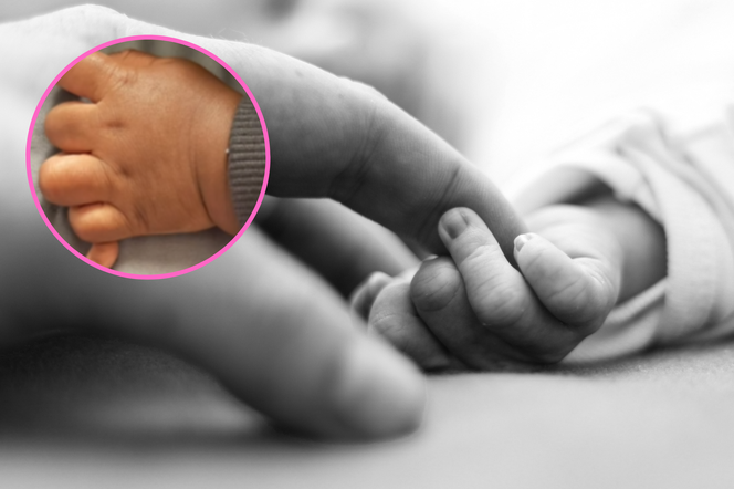 dodatkowy palec u rąk niemowlęcia