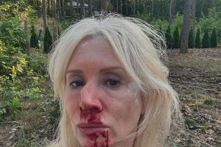 Ewa Gawryluk (Ewa z Pierwsza miłość) po wypadku na planie 