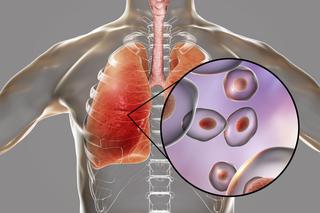 Pneumocystozowe zapalenie płuc (pneumocystoza): przyczyny, objawy, leczenie