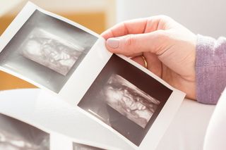 Badanie USG pokazało coś szokującego w czaszce dziecka. Nawet lekarze nie mogli uwierzyć
