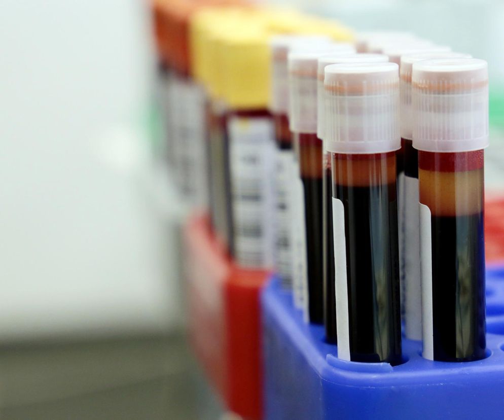 Wysoki poziom cukru groźny nie tylko dla diabetyków. Sprawdź, czy jesteś w grupie ryzyka