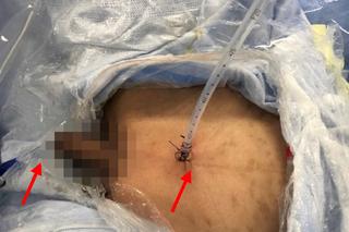 12-latek włożył sobie termometr do penisa. Szokująca zabawa erotyczna nastolatka