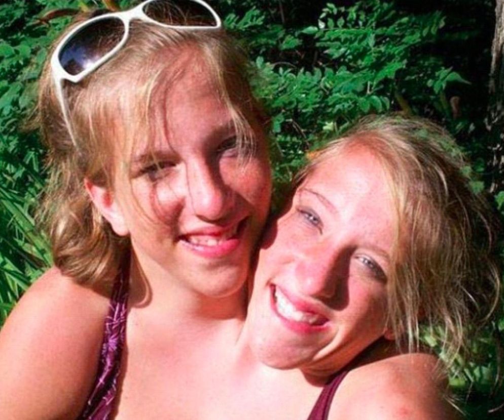 Dawniej sprzedawano je do cyrków, dziś też budzą zainteresowanie. Życie (i śmierć) bliźniąt syjamskich 	