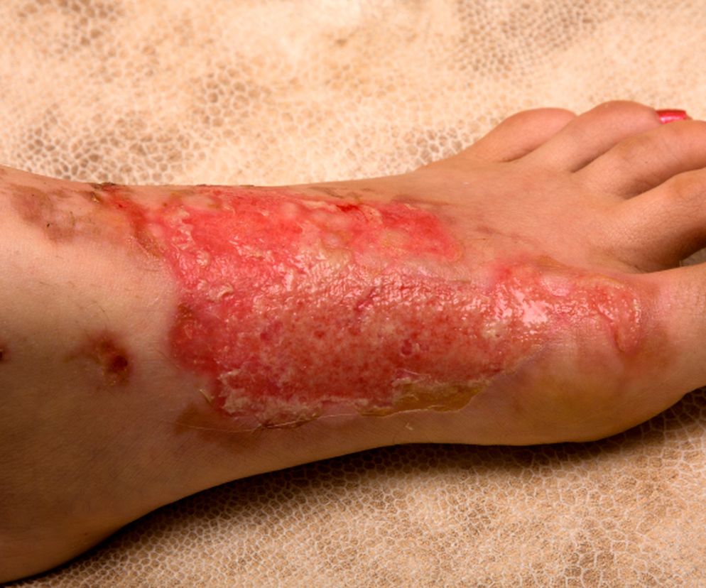 OPARZENIA - rodzaje, stopnie 
 oparzeń i ich charakterystyka