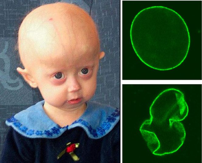 Progeria: przedwczesna starość. Przyczyny i objawy przedwczesnego starzenia się