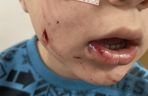 Pies pogryzł 4-letniego Frania. Chłopczyk w szpitalu, policja szuka właściciela