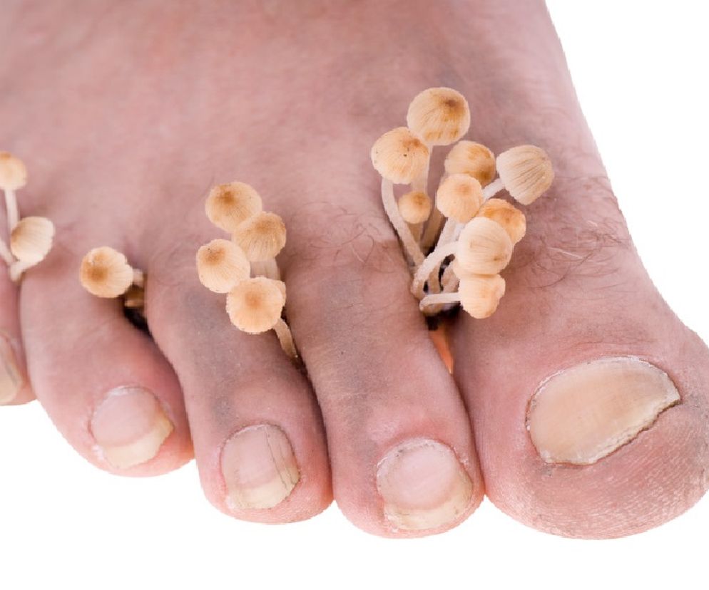 Uwaga, grzybica może być groźna