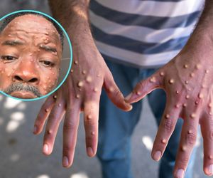 Ponad 500 nowych zakażeń w tydzień! Epidemia ogarnia Afrykę, rządy biją na alarm