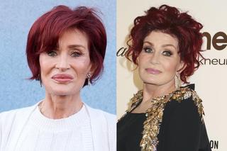 Ozempic face Przerażające efekty magicznej diety! Ekspertka bije na alarm