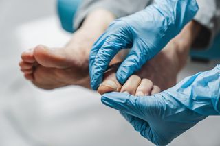 Grzybica paznokci to częsty problem. Poznaj objawy i skuteczne metody leczenia