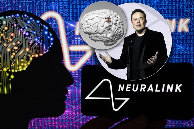 Elon Musk wszczepia ludziom chipy! Wielki eksperyment rozpoczęty