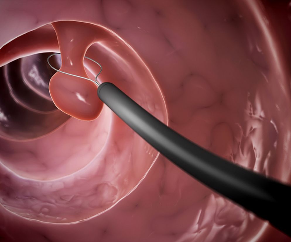 Czy usuwanie polipów jest konieczne?