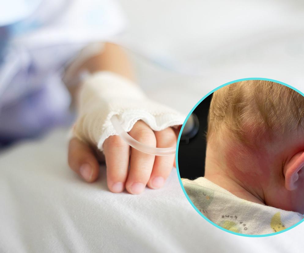 Jej synek miał niepokojące objawy - wysoką gorączkę i dziwną wysypkę. Jego skóra była zaogniona