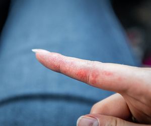 Alergia na nikiel. Czego unikać, mając alergię na nikiel?